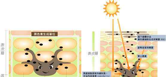 激光能祛斑吗 脸上很多雀斑，用激光能祛斑吗？