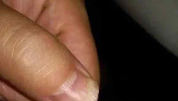 严重缺维生素指甲图片 手指甲长这样，多半是身体在“求救”！6种变化一个比一个危险，赶紧自查~
