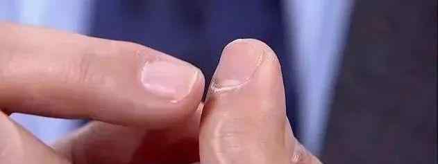 关于指甲的病 手指甲长这样，多半是身体在“求救”！6种变化一个比一个危险，赶紧自查~