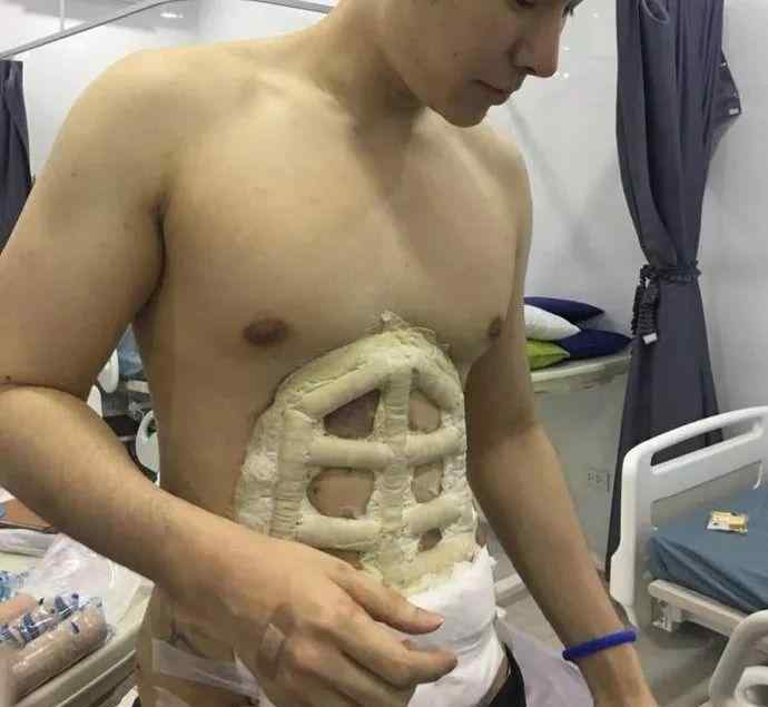 泰国男子通过手术做了六块“人造腹肌”!