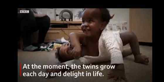 非洲父亲挽救双胞胎连体女儿之路