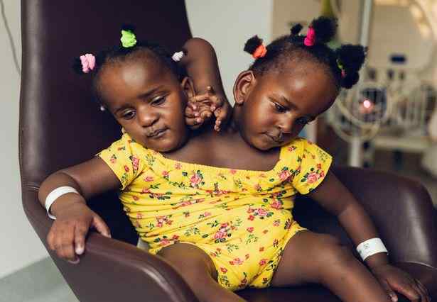 非洲父亲挽救双胞胎连体女儿之路