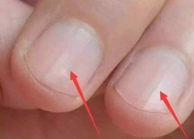 指甲出现凹陷 为什么你的指甲凹陷不平整？可能原因有3个