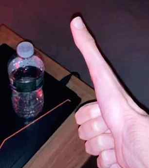 世界上最长的拇指：大学生雅各布·皮纳