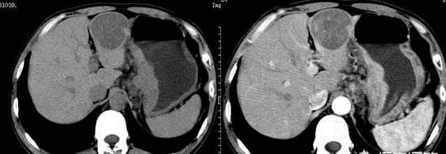 肝内低密度灶什么意思 CT扫描肝脏内见低密度灶这是什么意思，身体会有什么表现？