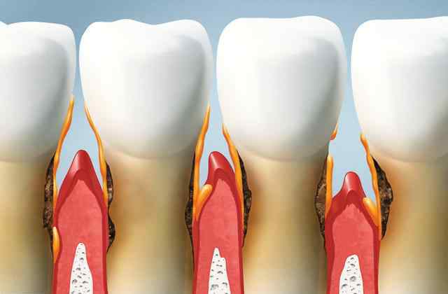 拔牙根疼吗 牙根纵裂必须拔掉吗有种“隐形疼痛”叫牙根纵裂？