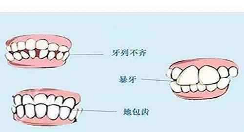牙齿矫正时间 一般的牙齿矫正时间需要多长时间