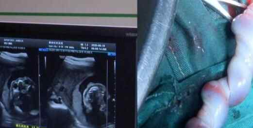 湖南长沙女子怀孕8个月腹中突然没动静 医生剖腹手术后看到可怕一幕