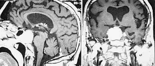 鞍隔 容易误诊为垂体瘤的鞍隔脑膜瘤