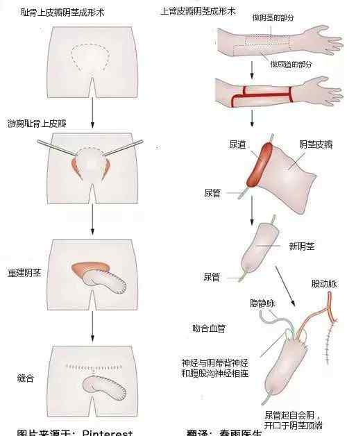 女变男手术后恢复图 医学解密：变性手术过程图示（女变男）