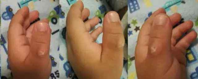 安抚奶嘴的利弊崔玉涛 小孩子频繁吃手弊端多，可能导致手指变形脱皮