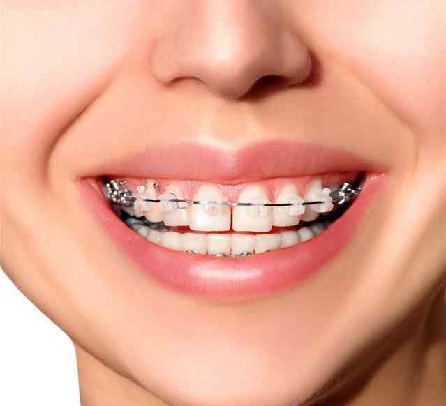 矫正牙齿方法 让人闻风丧胆的牙齿黑三角，比蛀牙更可怕！修复方法来了