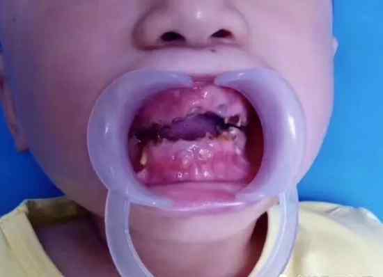 6岁宝宝牙齿烂到牙根了 气得发抖，6岁小孩一嘴烂牙，竟是家长多年的不作为