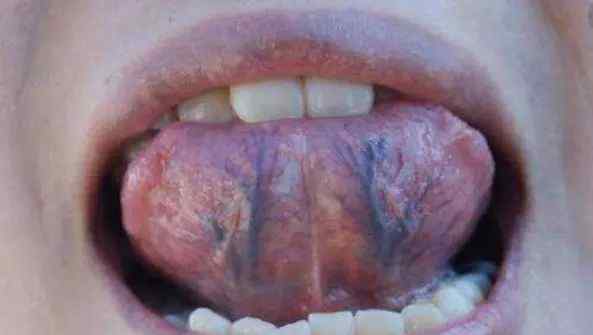 舌下静脉瘀堵四级照片 舌下两条静脉又黑又粗，可要小心身体状况了，很危险