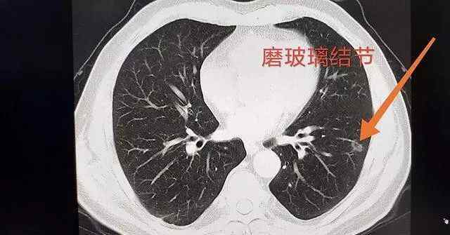 肺部磨玻璃影 肺部磨玻璃样影到肺癌有多远？