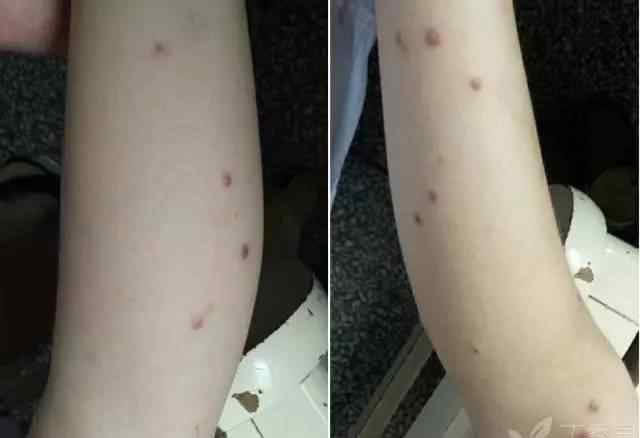 皮疹的症状 这 4 个皮疹病例，你的诊断对了几个？