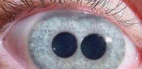 人快死时瞳孔图片 人类5种罕见的瞳孔