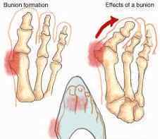 脚大拇指关节外翻 女性常见脚部畸形：拇指外翻！