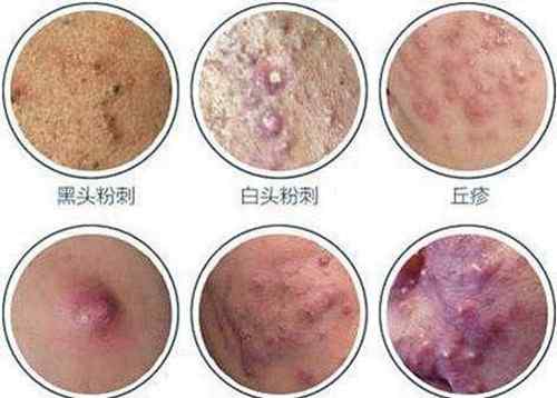 痤疮如何治疗 痤疮怎么治疗才最彻底？这些细节需注意文章配图