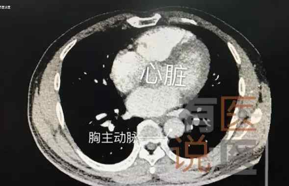 福州患肺癌女子被查出“镜面人”的身份，手术都难做文章配图