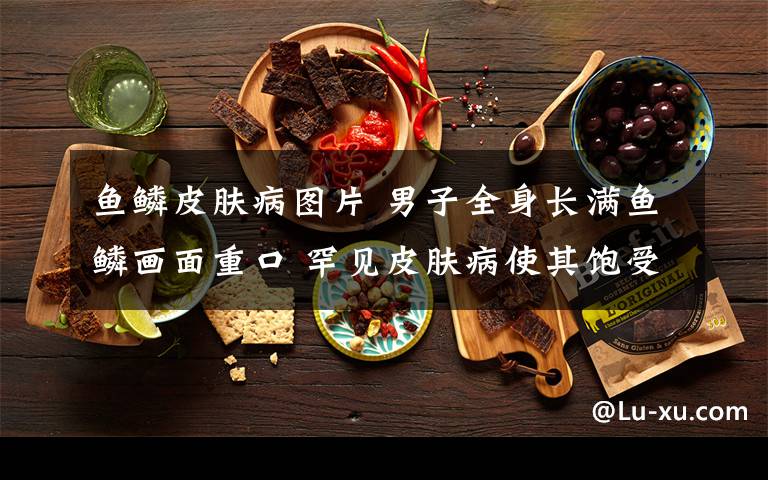 鱼鳞皮肤病图片 男子全身长满鱼鳞画面重口 罕见皮肤病使其饱受心理生理双重摧残!