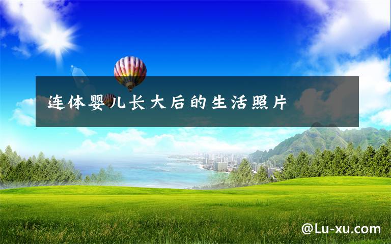 连体婴儿长大后的生活照片