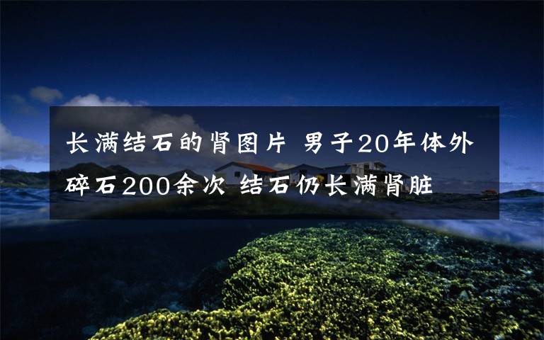 长满结石的肾图片 男子20年体外碎石200余次 结石仍长满肾脏