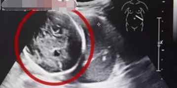 6月胎儿 怀孕6月子宫为空怎么回事？胎儿长在腹腔内存活率仅为1%