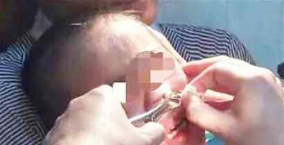 决明子的危害 决明子进鼻孔发芽怎么回事？决明子有什么危害 医生：不建议玩