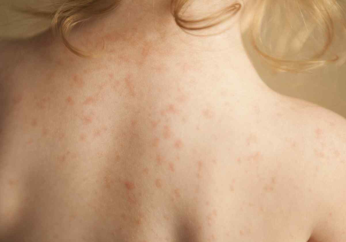 湿疹发炎 湿疹，皮肤发炎 - 天然治疗方法