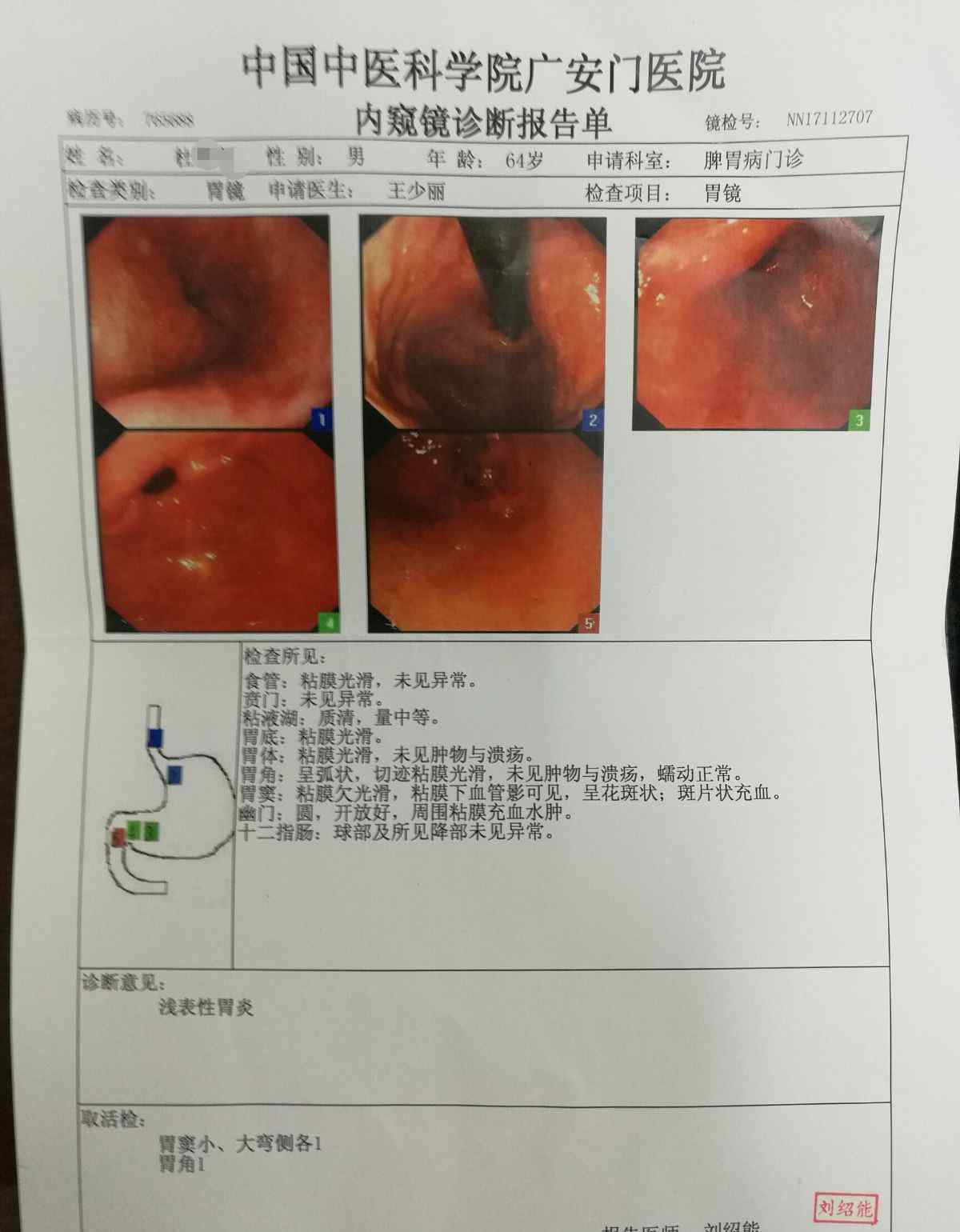 慢性萎缩性胃炎治疗 重度慢性萎缩性胃炎伴重度肠化生治疗三个月余逆转为浅表性胃炎