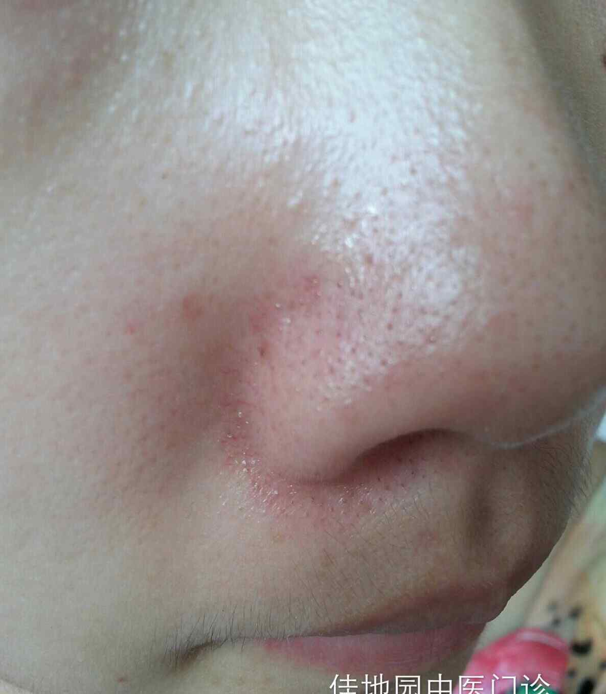 干性脂溢性皮炎症状 脂溢性皮炎