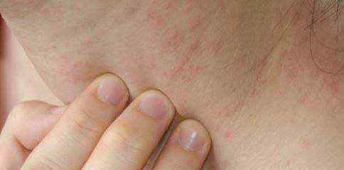 皮肤湿疹怎么治疗?