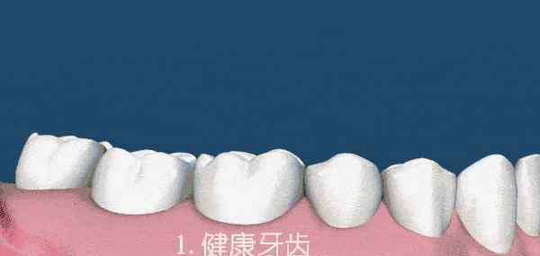 什么牙龈萎缩能够修复?