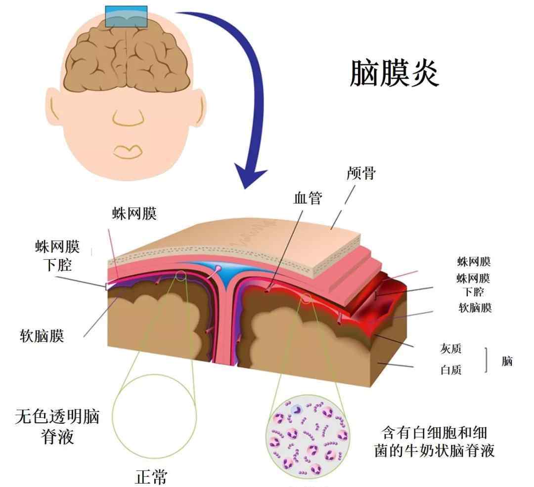 脑膜炎球菌心肌炎临床流行病学