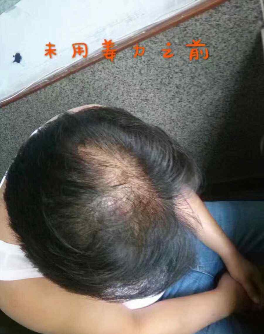 头发头顶少 头顶漩涡为什么头发少？