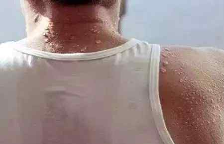 夏天常见的皮肤病(如急或亚急性皮炎、脓皮病、皮肤湿疹、热痱子