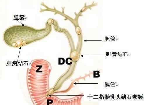 外国人对胆囊切除观点切胆不良影响太比较严重,一定要三思!