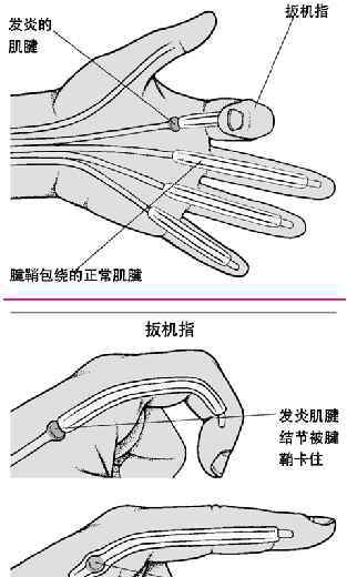 “扳机指”的别的医治如保守治疗失效