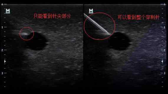 穿刺针 迈瑞超声功能介绍之穿刺针增强