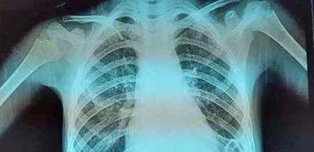 肺钙化什么意思 肺部钙化灶