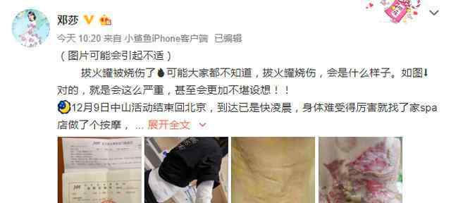 邓莎微博 邓莎拔火罐被烧伤 微博晒伤势图背后大面积起泡