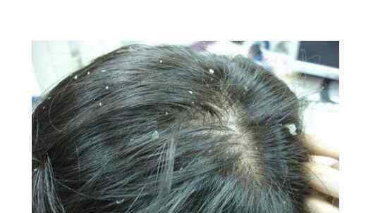 头皮屑多是什么原因男 男士头皮屑多怎么办 头皮屑多的治疗方法