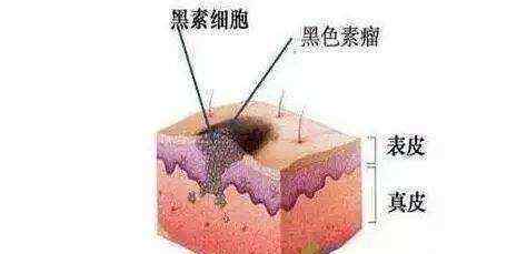 甲黑线 黑色变的甲黑线到底是怎么回事？