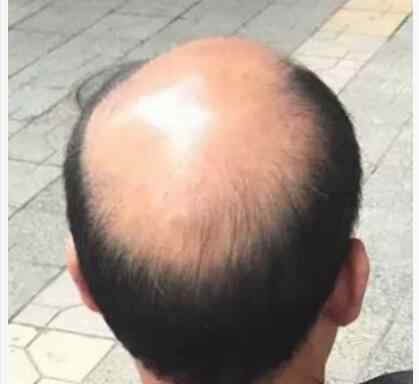 中间秃顶发型 中间秃顶男士流行发型图片 来看看秃顶发型如何扎