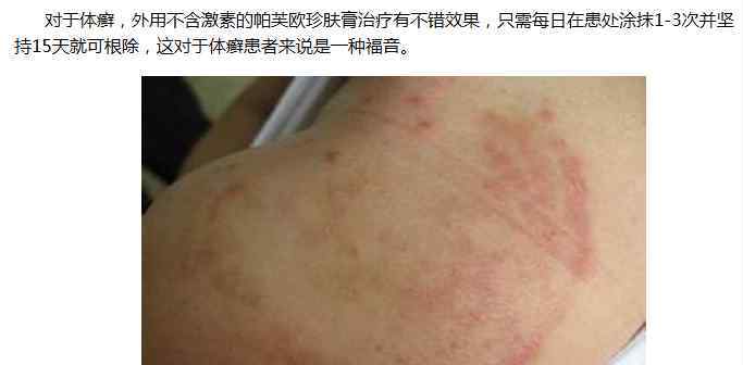体癣的前期照片病症无非二种
