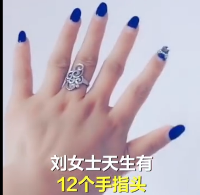 女子天生12根手指，自嘲六指琴魔，网友：毫无违和感真相是什么？