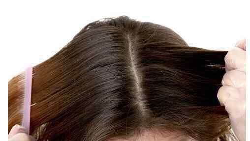 头屑多是什么原因 头皮屑多是什么原因 导致头皮屑多常见原因