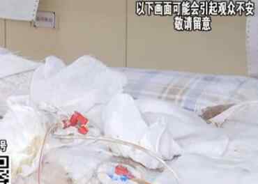 火人 惨不忍睹！少女洗澡煤气爆炸 17岁女孩出来时全身上下已是“火人”