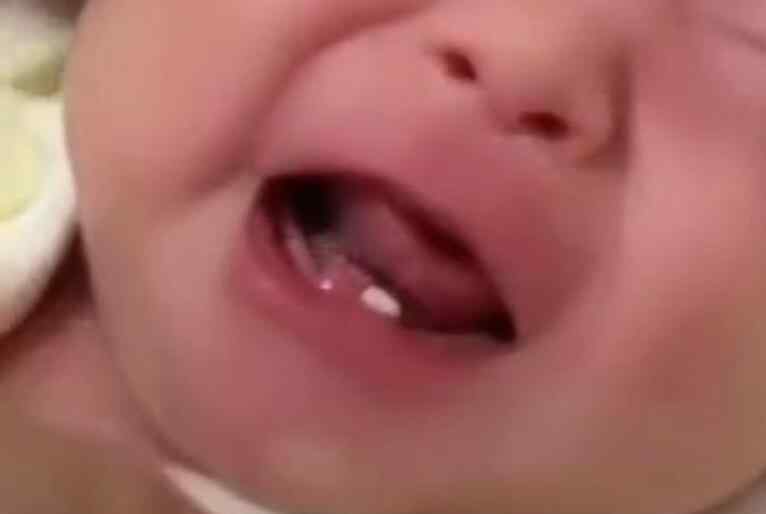 婴儿出牙前的牙包图片 奇怪！女婴出生长两颗牙 医生告诉她这种牙叫做“诞生牙”